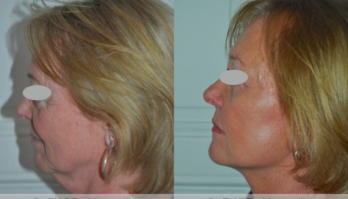Lifting Cervico Facial