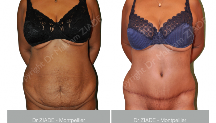Dr ZIADE - Abdominoplastie Montpellier