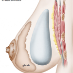 illustration d'une prothèse mammaire prémusculaire par le chirurgien esthétique ZIADE à Montpellier