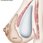 illustration d'une prothèse mammaire rétro musculaire par le docteur ziade à montpellier