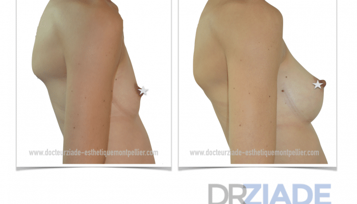Augmentation mammaire avec un effet naturel Montpellier - Dr ZIADE
