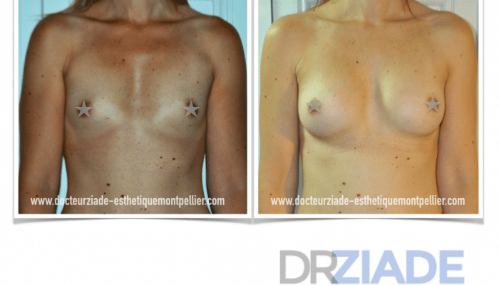 augmentation mammaire par prothèse Dr Ziade