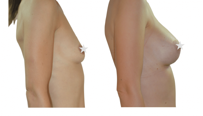 Augmentation mammaire par prothèses anatomiques à Mpontpellier
