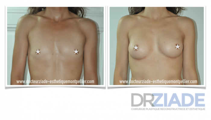 Prothèses mammaires par Dr ZIADE - chirurgien esthétique à montpellier