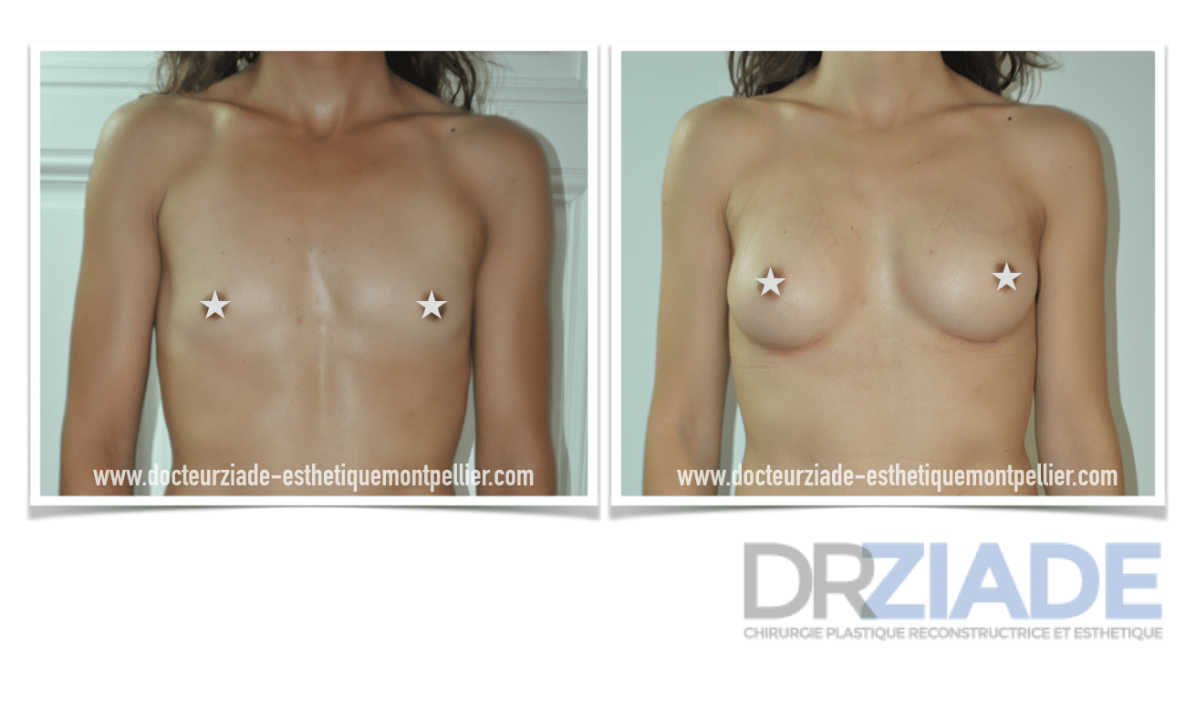 Prothèses mammaires par Dr ZIADE - chirurgien esthétique à montpellier