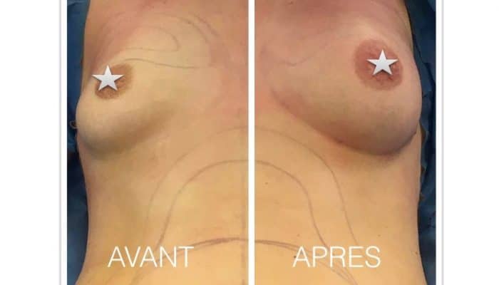 Augmenter le volume de ses seins sans prothèse