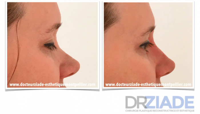 Changer la forme de son nez sans chirurgie - Acide hyaluronique montpellier