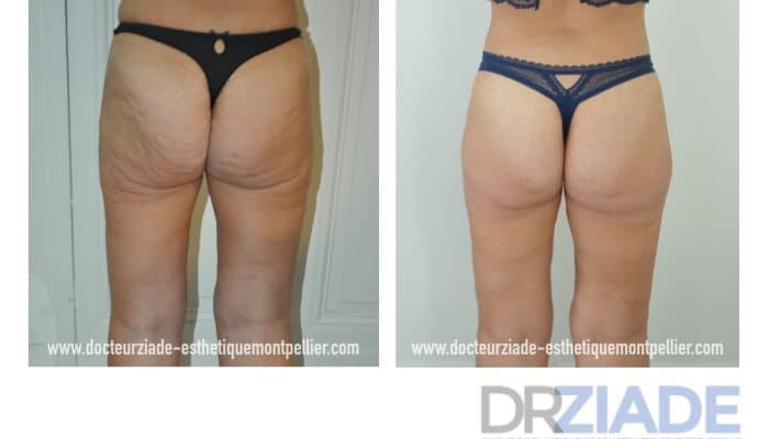 bodylift pour la silhouette
