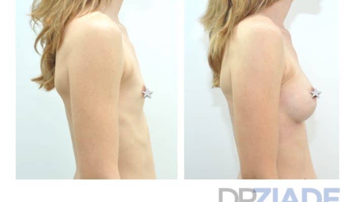 Augmenter le volume de ses seins par prothèse