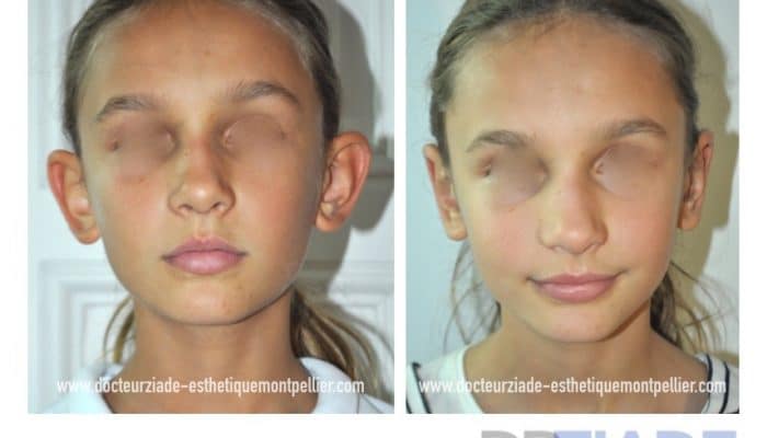 Chirurgie des oreilles décollées sans hospitalisation