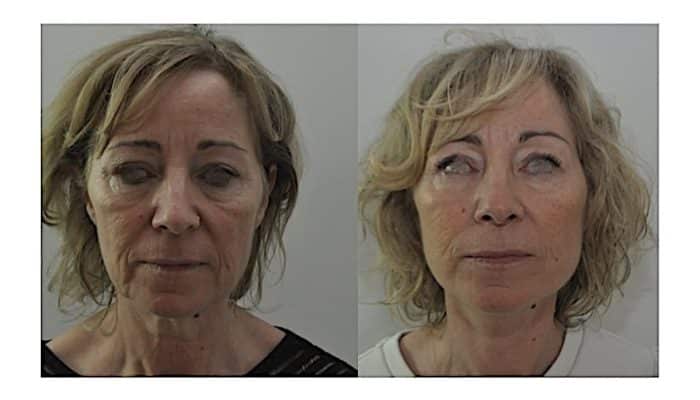 Lifting cervico-facial