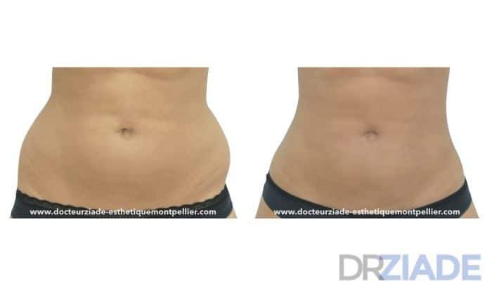 Lipoaspiration des poignées d'amourMontpellier