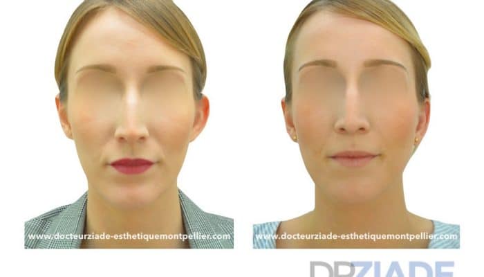 Correction des oreilles décollées par le Dr ZIADE, Chirurgien esthétique à Montpellier