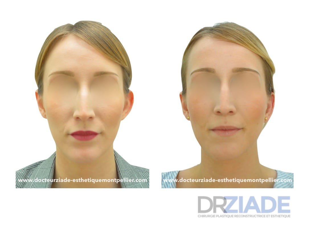 Correction des oreilles décollées par le Dr ZIADE, Chirurgien esthétique à Montpellier