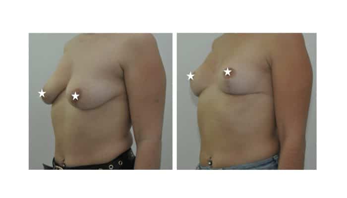 Avant / Après lifting mammaire
