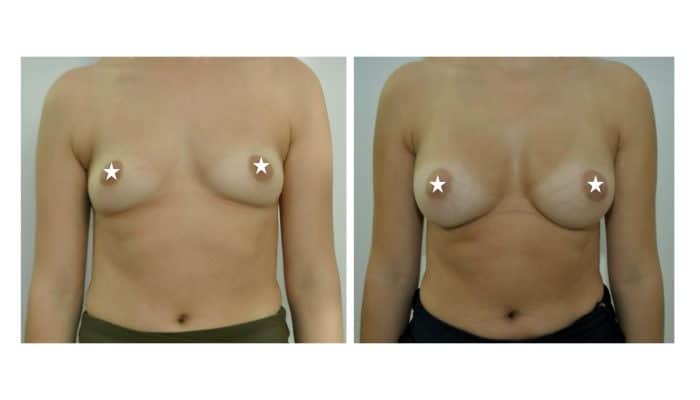 Avant / Après Augmentation mammaires