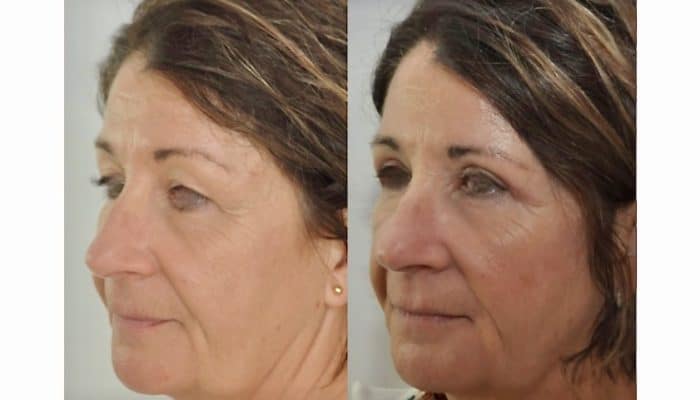 Blépharoplastie supérieure