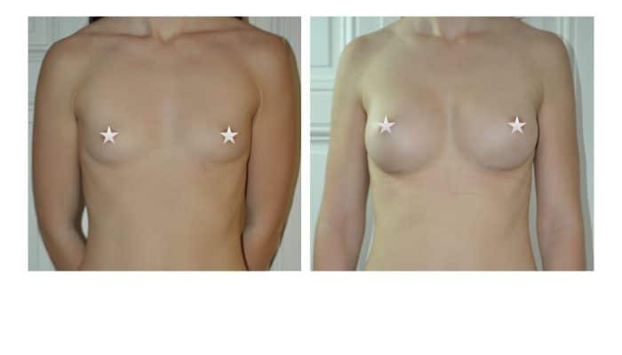 Augmentation mammaire montpellier