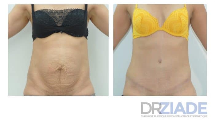 Abdominoplastie Montpellier