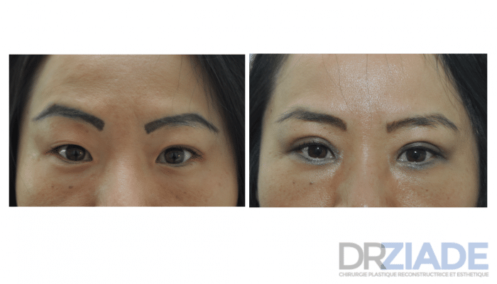 photo avant après d'une blépharoplastie asiatique