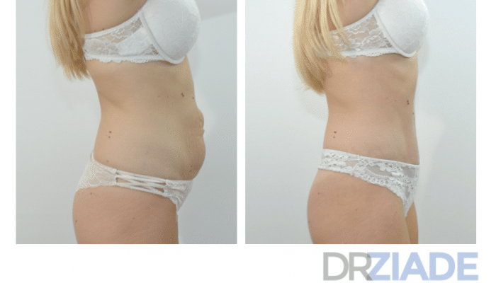 abdominoplastie Montpellier