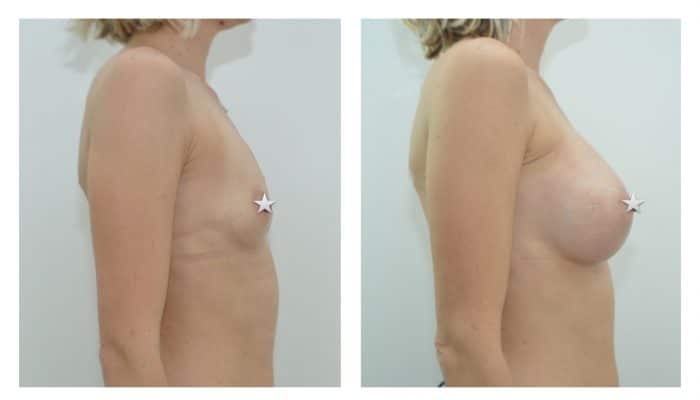 comment choisir son implant mammaire