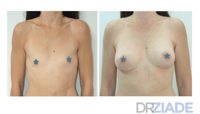 augmentation mammaire montpellier