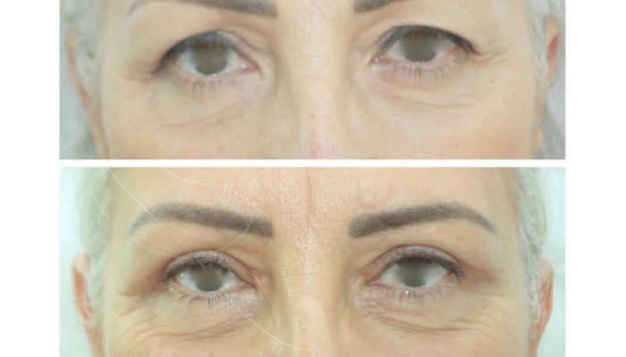 Blépharoplastie supérieure