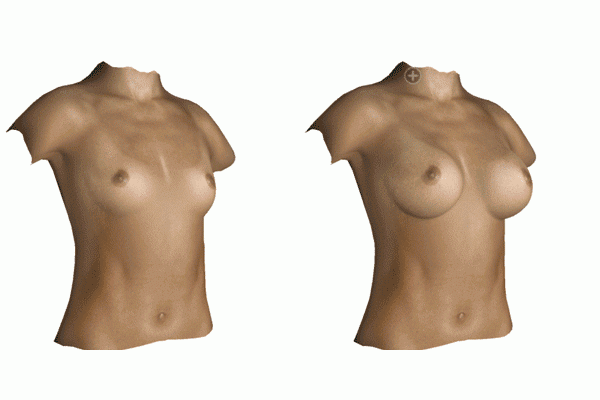 simulation 3D avant après d'une augmentation mamaire