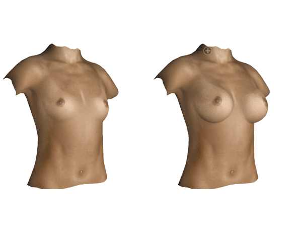 simulation 3D avant après d'une augmentation mamaire