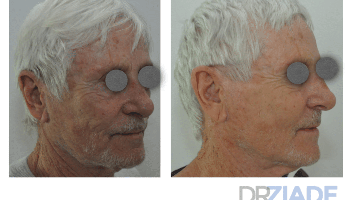 avant/après lipostructure visage