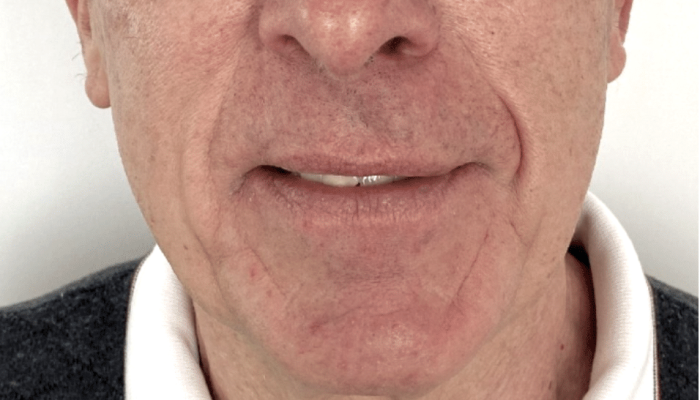 avant après lifting visage homme