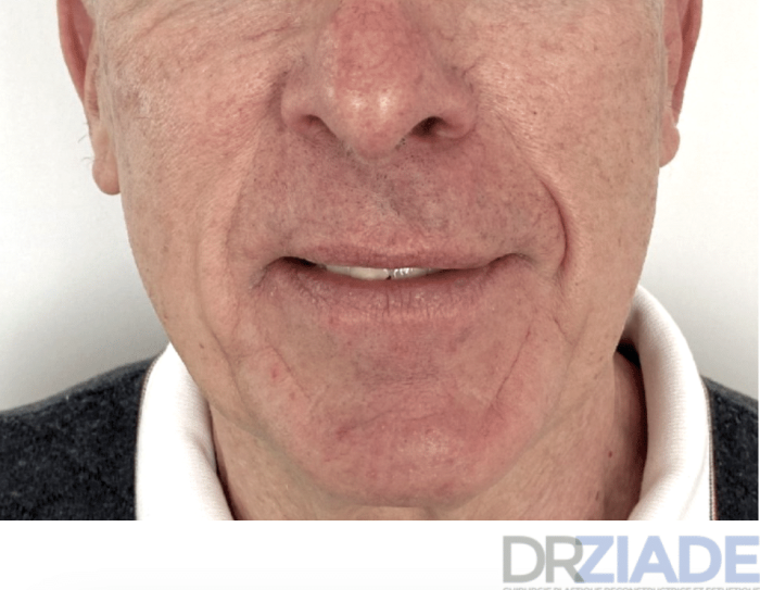 avant après lifting visage homme